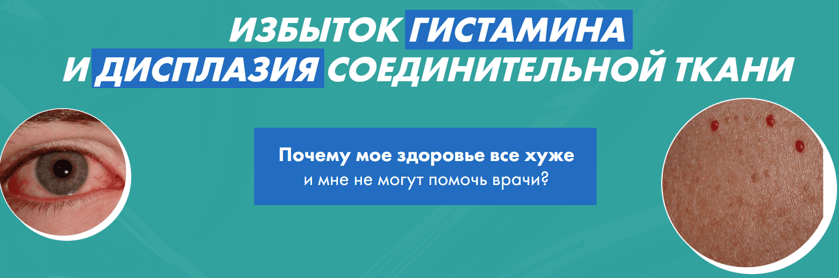 [Дарья Ермишина] Избыток гистамина и дисплазия соединительной ткани (2025)